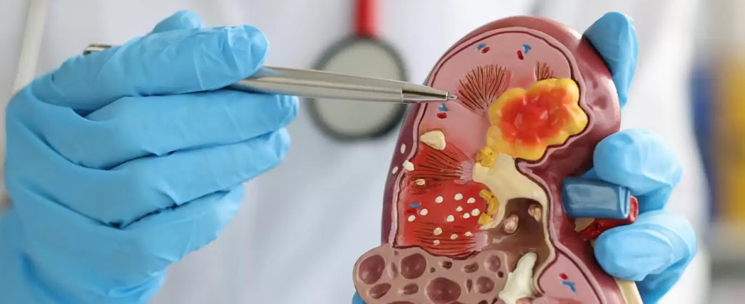 Percutaneous Kidney Stone Surgery