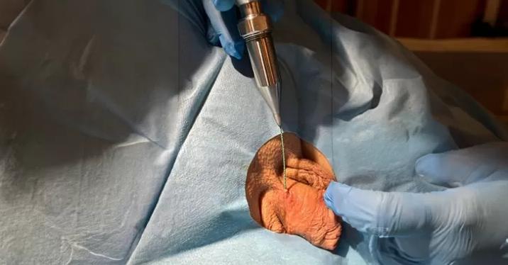 Криотерапия