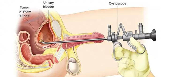 Cystoscopy (Bladder and Urethra Imaging)