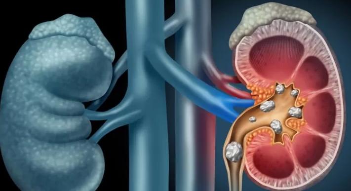 Vesicoureteral Reflux (VUR)
