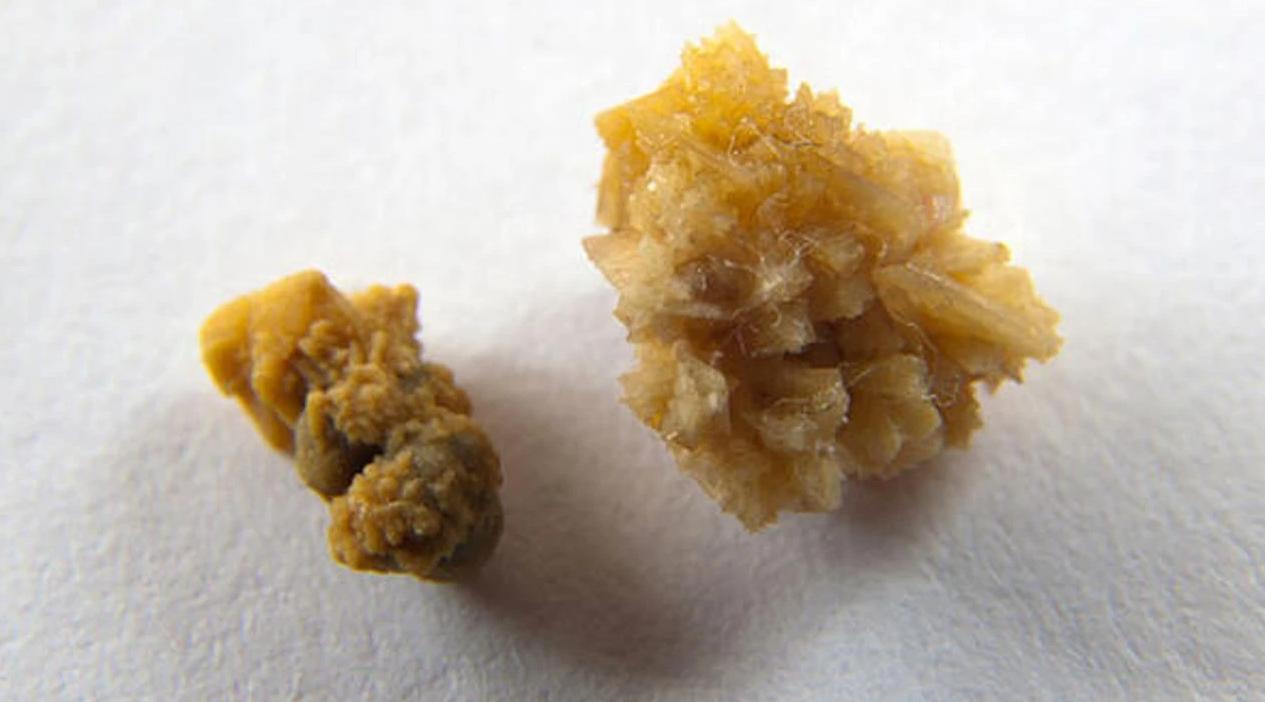 A kidney stone is a hard crystalline structure formed by the accumulation of minerals and salts i...