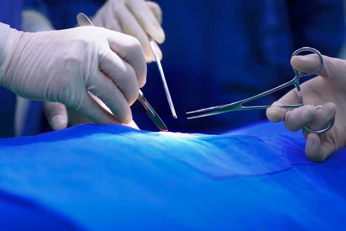 Vazektomi, erkeklerde sperm taşıyan t plerin bağlanması ile yapılan bir doğum kontrol y ntemidir....