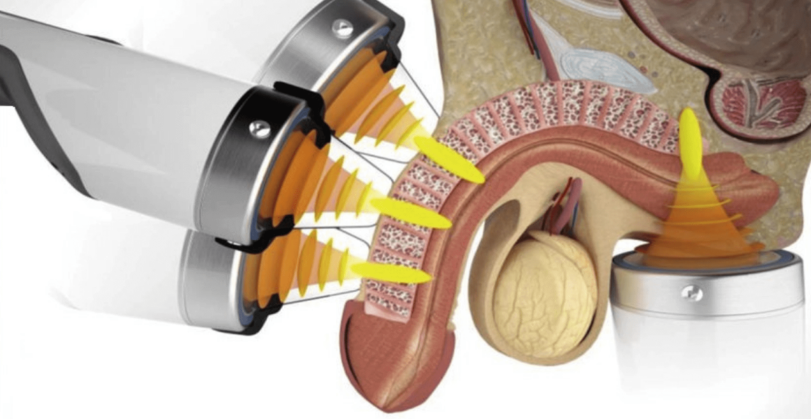 ESWT stands for Extracorporeal Shock Wave Therapy. It involves applying low-intensity shock waves...